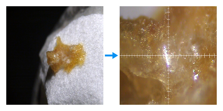 Cholesterol crystal specimens floating in blood vessels are suction-filtered on filter paper and a nitrocellulose filter (0.45 mm) and dried.