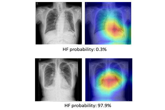 古徳純一教授らの研究グループが心不全患者の予後予測を可能にする胸部単純X線画像を用いた人工知能（AI）を開発しました